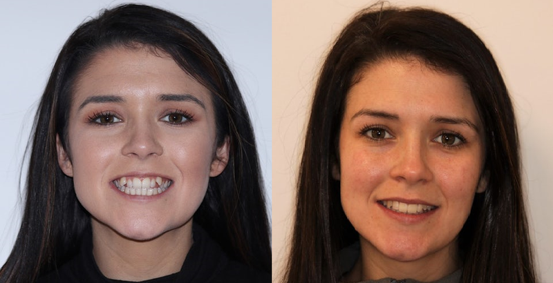 What Are Metal Braces?